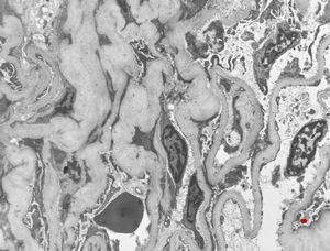 M,29y. | developing glomerulosclerosis M,29y. | developing glomerulosclerosis